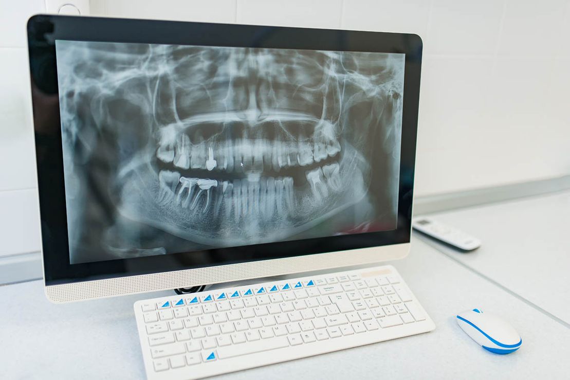 Digitales Zahnröntgen